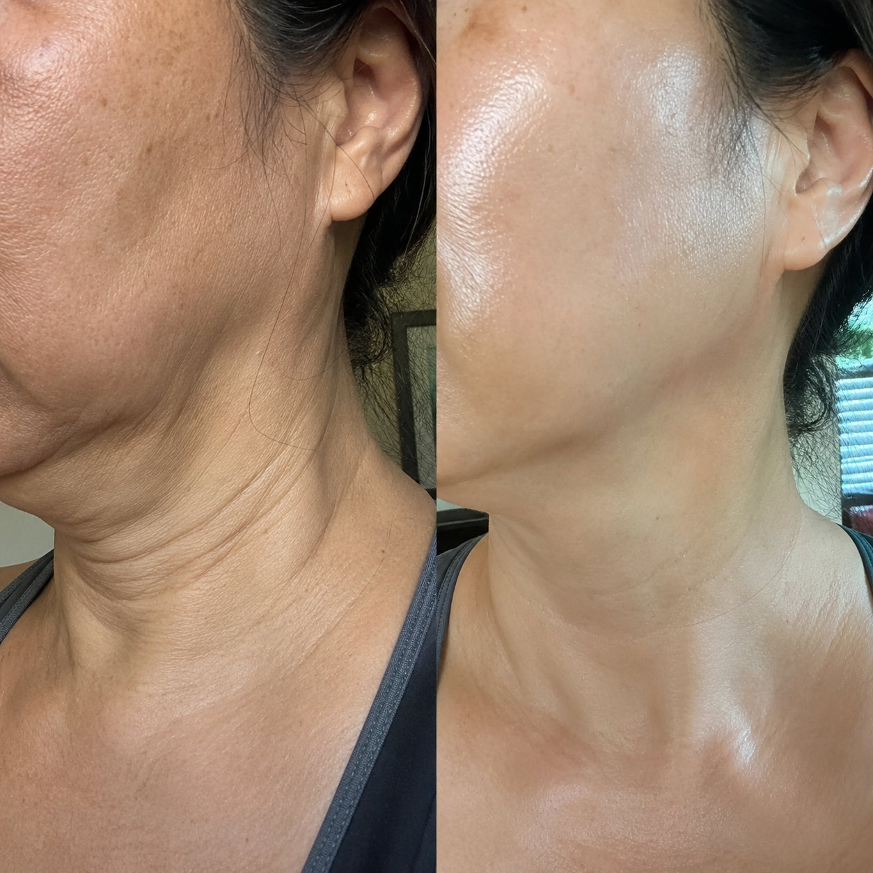 Teresita S. before and after result
