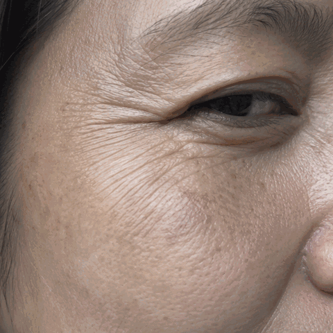 Luz D. Seoulderm before and after result
