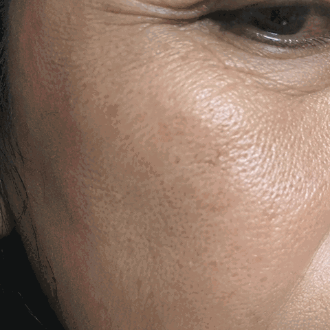 Annie M. Seoulderm before and after result